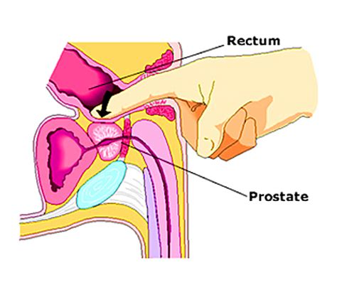 An external prostate massage device is a soft rubbery device that is shaped similar to a bike seat. The Prostate Massage Therapist - Do You Really Need ...