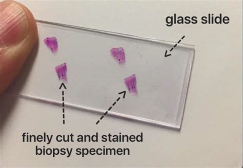 Biopsies are performed for various reasons, though the most common is as a diagnostic tool. Preparing a Scalp Biopsy — Donovan Hair Clinic