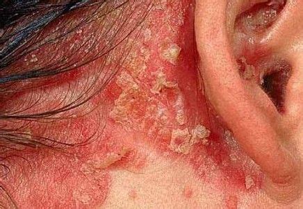 Ringworm, or tinea, is a skin problem caused by fungus. Doctor Vignjevic | Psoriasis (With images) | Psoriasis, Psoriasis medication, Scalp psoriasis