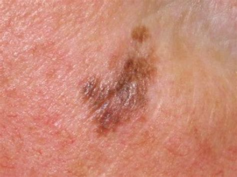 More sunburns at any age. Rapidly rising rate malignant melanoma Scottsdale Phoenix