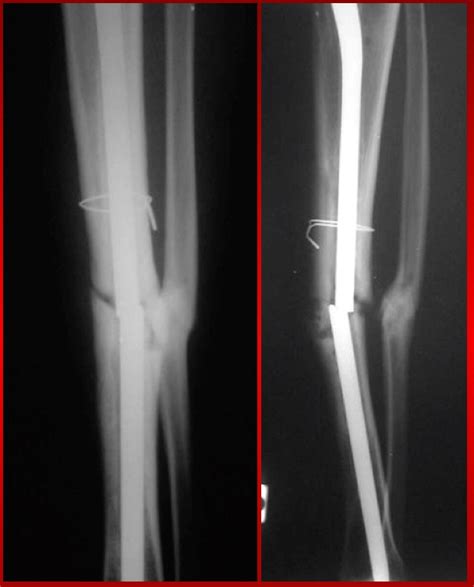 Dr PILI Ortopedico specialista trattamento Pseudoartrosi ...