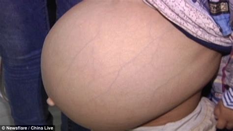 We did not find results for: Video shows Chinese boy with huge stomach thatparents have ...