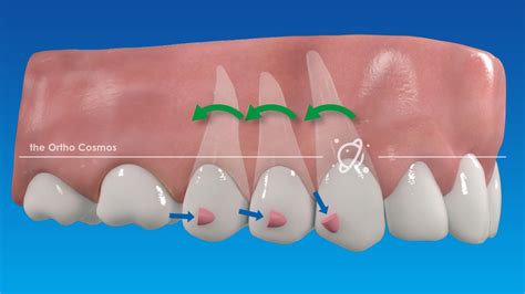 Cleaning your aligners keeps them invisible. Traditional Attachments vs Aligner Optimization - The ...