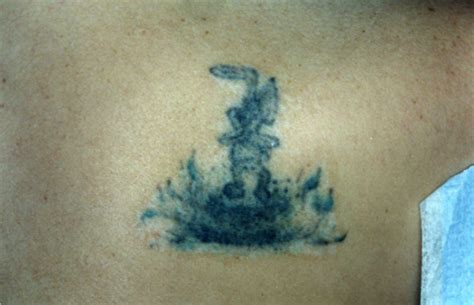 Anne taylor for laser tattoo removal in columbus, ohio. Columbus OH Laser Tattoo Removal Before and After Photos ...