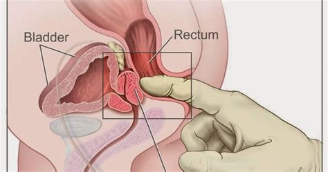 Benign prostatic hyperplasia (bph), also known as benign prostatic hypertrophy, is a histologic diagnosis characterized by proliferation of the cellular elements of the prostate. Le cancer de la prostate | Récap' IDE