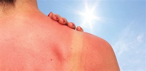 Cancer is more than 100. Melanoma: The Most Common Form of Cancer - Healthy Kansas City
