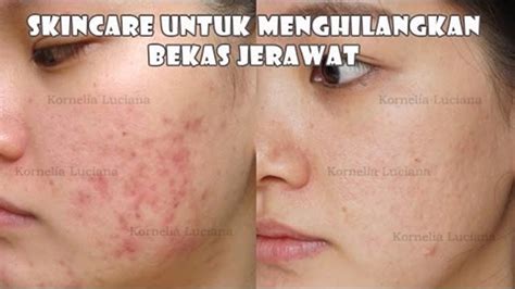 3 x sumber tepercaya pubmed central kunjungi sumber mikrodermabrasi akan mengikis lapisan kulit di sekitar luka parut, meratakan permukaan kulit, dan memudarkan cekungan dan noda hitam bekas jerawat. Skincare Untuk Menghilangkan Bekas Jerawat | Kornelia ...