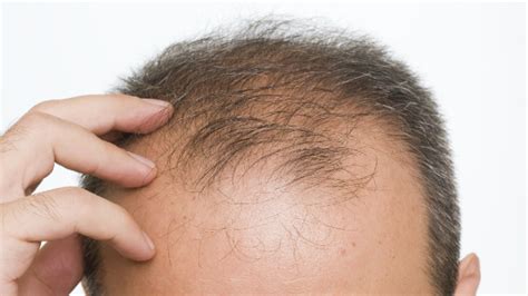 Follicular miniaturization in female pattern hair loss: New drug for alopecia shows promise | WBAL NewsRadio 1090 ...