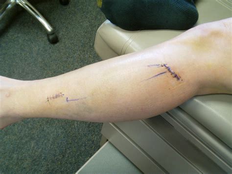 Common peroneal nerve dysfunction is a type of peripheral neuropathy. Common Peroneal Nerve — Page 2