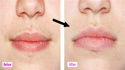 As such, prices can vary based on treatment areas as well as hair types and skin sensitivity. Permanent Upper Lip Hair Remove - YouTube