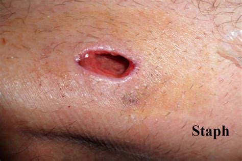 An ingrown hair cyst can be deep and painful in areas with hair such as the swimsuits, thighs, neck, face and armpits. Infected Ingrown Hair: Symptoms and Treatments | New ...