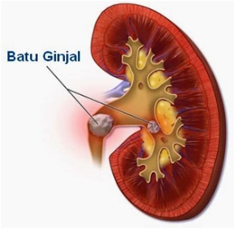 Faktor menyebabkan kemalangan jalan raya; Faktor Penyebab Penyakit Batu Ginjal, Jika Dibiarkan ini ...