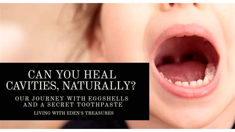 Can you heal a cavity. Can You Heal Cavities, Naturally? Part 1 - Living With ...