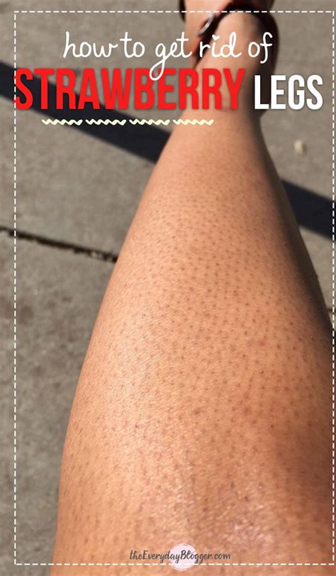In addition to reducing the appearance of strawberry legs, exfoliation. How to Get Rid of Strawberry Legs | Strawberry legs ...