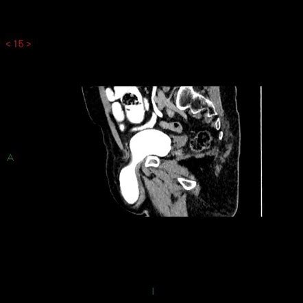 Maybe you would like to learn more about one of these? Scrotal cystocele | Radiology Reference Article ...