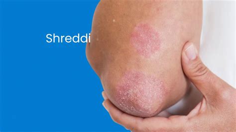 Included is detail on triggers for outbreaks, ways spread can be prevented, and risk factors for the condition. How Do You Stop Psoriasis From Spreading? Homeopathy ...