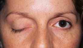 Remdesivir is an experimental medicine being studied for use in treating conditions caused by coronaviruses. Myasthenia gravis | Russian Federation| PDF | PPT| Case Reports | Symptoms | Treatment