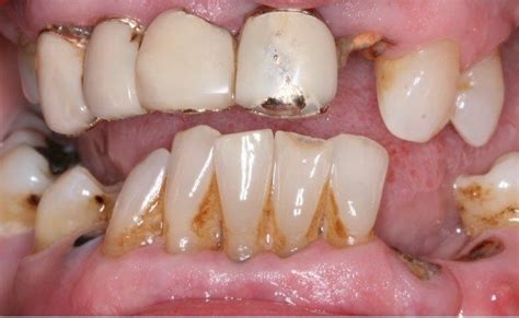Durch polizeiliche und notarielle aufsicht wird ein ordnungsgemäßer ablauf einer jeden ziehung sichergestellt. Zahnarztpraxis Ulrich Vogel: Wann sollten Zähne gezogen ...
