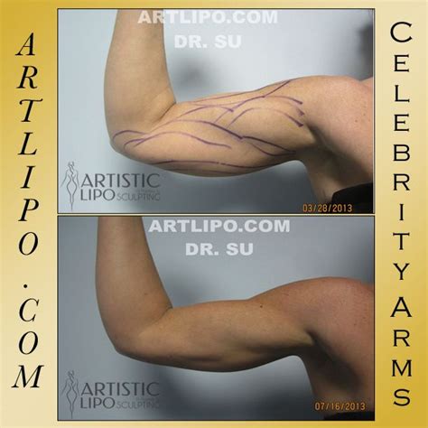 Maybe you would like to learn more about one of these? Revolutionary💥 #Celebrity #Arms #Liposuction # ...