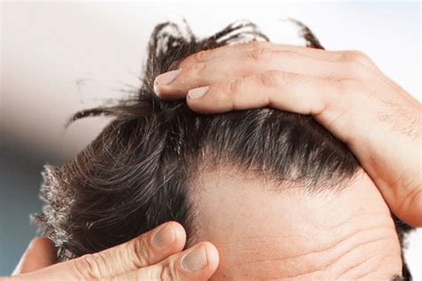 Thinning of hair has become a common problem for all these days. How To Stop Hair Thinning? » esteGrande Hair Transplant ...