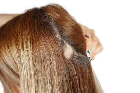 We did not find results for: Perte Cheveux Localisée Femme / L Alopecie En Plaques La ...