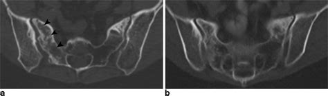 Miscellaneous Pelvic Effects: Pelvic/Sacral Insufficiency ...