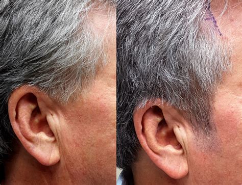 Traditionally, hair restoration surgeons transplant hair from the back and sides of men's scalps to over the past five years, facial hair restoration surgery has dramatically increased with this facial. Facial Hair Restoration Patient 3 | Limmer Hair Transplant ...