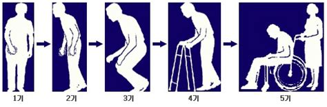 Check spelling or type a new query. 파킨슨병 초기증상 - 4대증상과 진행단계 : 네이버 블로그