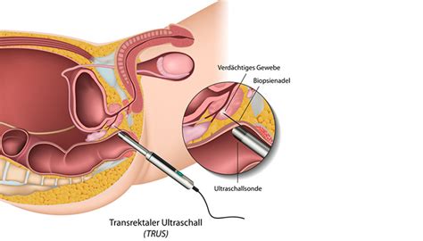 (image point fr / shutterstock). 53 Best Photos Prostatauntersuchung Ab Wann / Prostata ...