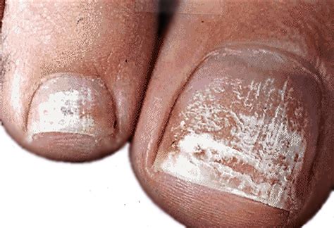 Nail abnormalities are problems with the color, shape, texture, or thickness of the fingernails or toenails. Footlab+ | Nailing the Diagnosis - Eastern Foot Care ...