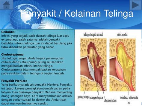 Gastritis bukan merupakan penyakit tunggal, tetapi terbentuk dari beberapa kondisi yang kesemuanya itu mengakibatkan peradangan pada hemoroid/wasir/ambeyen merupakan gangguan pembengkakan pada pembuluh vena disekitar anus. Indera Pendengaran (Telinga)