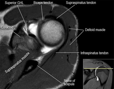 1, biceps tendon, long head. The Radiology Assistant : Shoulder MR - Anatomy ...