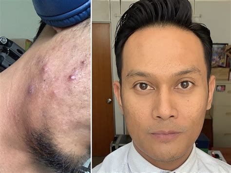 Sebab, munculnya benjolan di bagian tubuh manusia seringkali dikaitkan dengan kondisi serius, seperti penyakit kanker.tapi, benjolan ini tidak mutlak disebabkan oleh kanker saja. "Sekali Keluar Memang Besar Dan Bernanah, Jerawat Tu Macam ...
