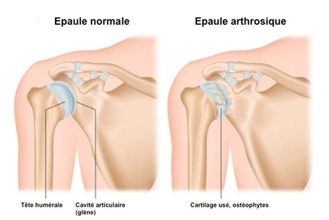 Elle permet une excellente vision de presque toute la région sans injection. Omarthrose - arthrose d'épaule