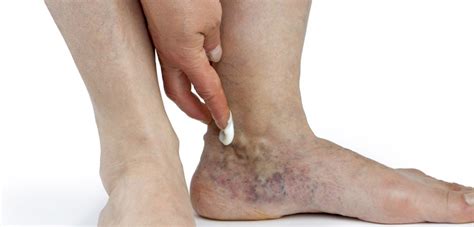 Symptoms can include pain, swelling, redness, and enlarged veins in the affected area. Homens com mais de 40 anos são as principais vítimas de trombose