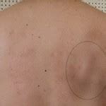 Lump on back near shoulder blade. Health and Medical Information