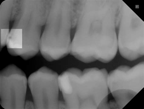 Unter initialkaries versteht man eine karies läsion (kariöse stelle am zahn) welche sich noch im zahnschmelz befindet. Zahnzwischenraumkaries und dentinadhäsive ...