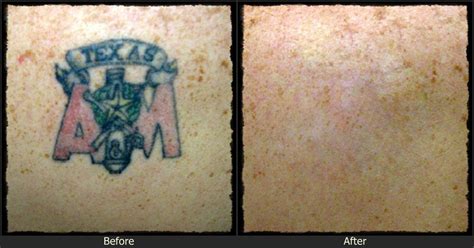 Home tattoo removal (under $10): #laser #tattoo removal costs, price laser tattoo removal ...