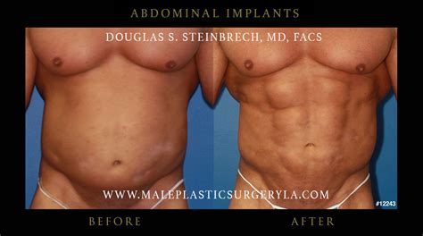 Your guide to the risks of cosmetic surgical. 6-Pack Abs Implants in Los Angeles, Beverly Hills, CA