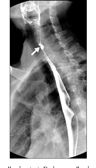It triggers the growth of. PDF Relapsed Esophageal Web in a Patient with Plummer ...