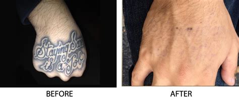 Black tattoo pigment absorbs all laser wavelengths, making it the the color of your skin, as well as how deep the tattoo pigment goes, will also affect the removal technique. Tattoo Removal Long Island | Good Tattoo Removal Long ...