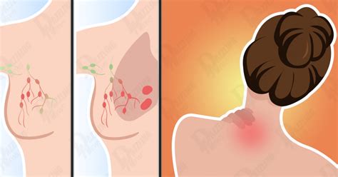 Breast cancer is the most common cancer in women after skin cancer. 9 COMMON breast cancer signs that most women IGNORE ...