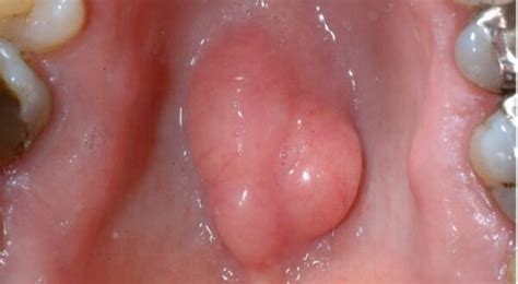 When you state tiny, roughly what size would you say it was in millimetres? Torus Palatinus (Bump on Roof of Mouth), Causes, Diagnosis ...