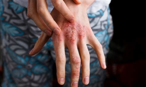 With all this in mind, how do full moons actually affect us? How Does Psoriasis Affect the Body? - U.S. Dermatology ...