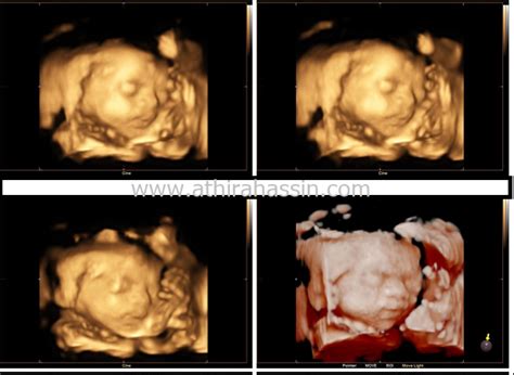 Demi membantu para master ataupun pengunjung setia situs kami dalam mendapatkan angka tafsir mimpi terakurat. Beza scan baby 2D 3D 4D 5D dan HD - athirahassin