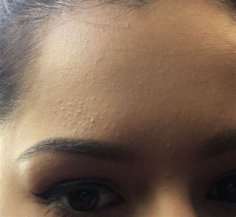 Von stephanie ridd als download. How I helped clear forehead bumps (subclinical acne) | How ...