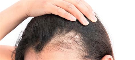 It's a very dynamic place and anything. 3 Triggers That Could Cause Sudden Hair Loss in Women ...