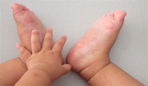 Mani-piedi-bocca: contagio, cause, sintomi, cure e prevenzione