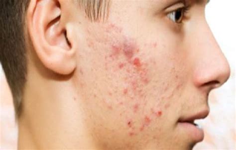 Ragam cara menghilangkan bekas jerawat. Cara menghilangkan Flek Hitam Bekas Jerawat