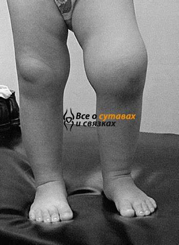 Ревматоидный артрит диета при обострении Ревматоидный артрит: симптомы и лечение Ревматоидный артрит: симптомы и лечение Ревматоидный артрит диета при обострении